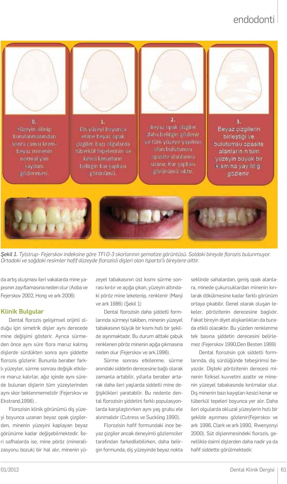 da artış oluşması ileri vakalarda mine yapısının zayıflamasına neden olur (Aoba ve Fejerskov 2002, Hong ve ark 2006) Klinik Bulgular Dental florozis gelişimsel orijinli olduğu için simetrik dişler