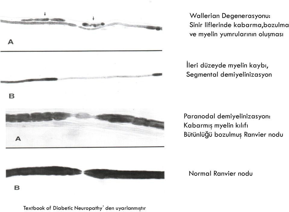 demiyelinizasyon Paranodal demiyelinizasyon: Kabarmış myelin kılıfı