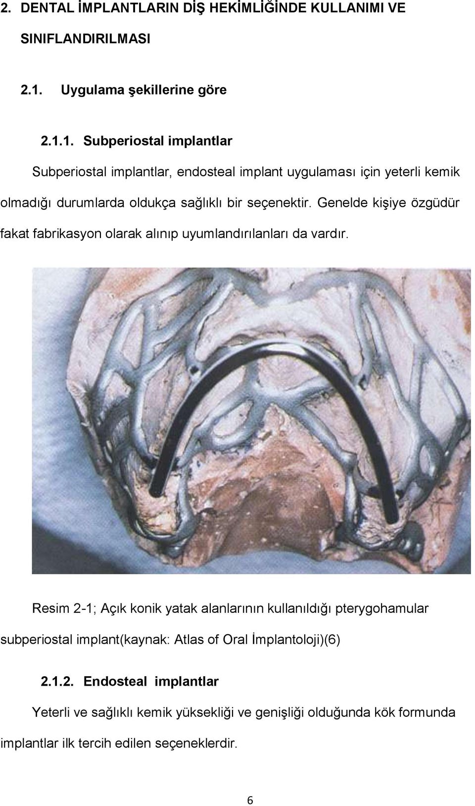 1. Subperiostal implantlar Subperiostal implantlar, endosteal implant uygulaması için yeterli kemik olmadığı durumlarda oldukça sağlıklı bir seçenektir.