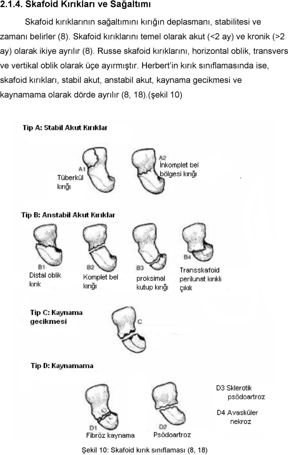 Russe skafoid kırıklarını, horizontal oblik, transvers ve vertikal oblik olarak üçe ayırmıştır.