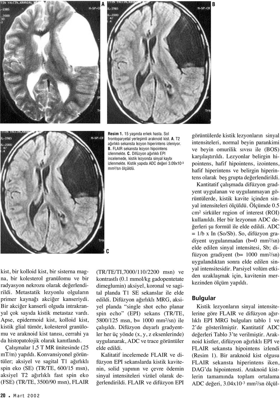 Apse, epidermoid kist, kolloid kist, kistik glial tümör, kolesterol granülomu ve araknoid kist tan s, cerrahi ya da histopatolojik olarak kan tland. Çal şmalar 1,5 T MR ünitesinde (25 mt/m) yap ld.