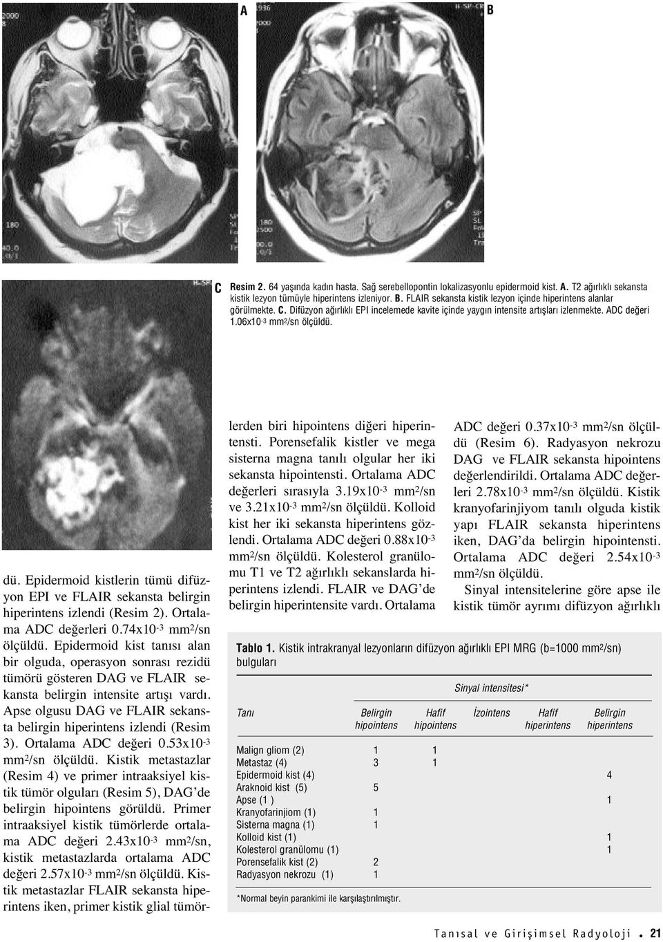 Epidermoid kistlerin tümü difüzyon EPI ve FLAIR sekansta belirgin hiperintens izlendi (Resim 2). Ortalama AD değerleri 0.74x10-3 mm 2 /sn ölçüldü.
