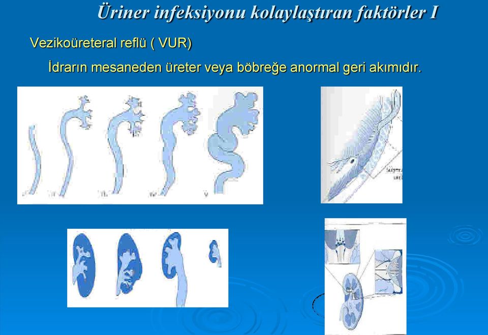 ( VUR) İdrarın mesaneden üreter