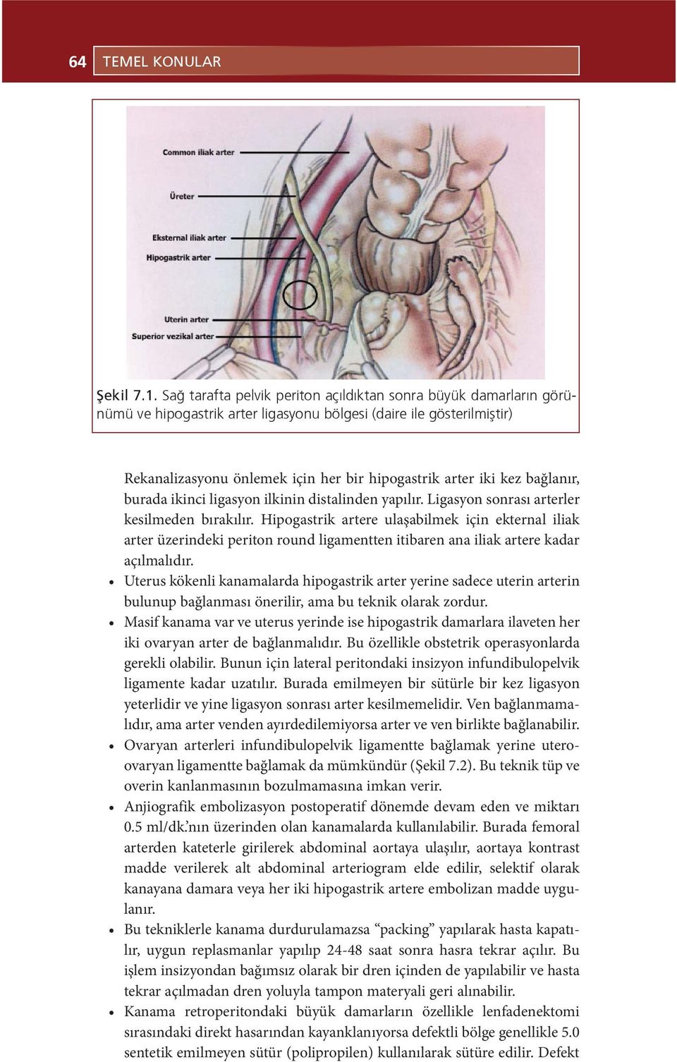 bağlanır, burada ikinci ligasyon ilkinin distalinden yapılır. Ligasyon sonrası arterler kesilmeden bırakılır.