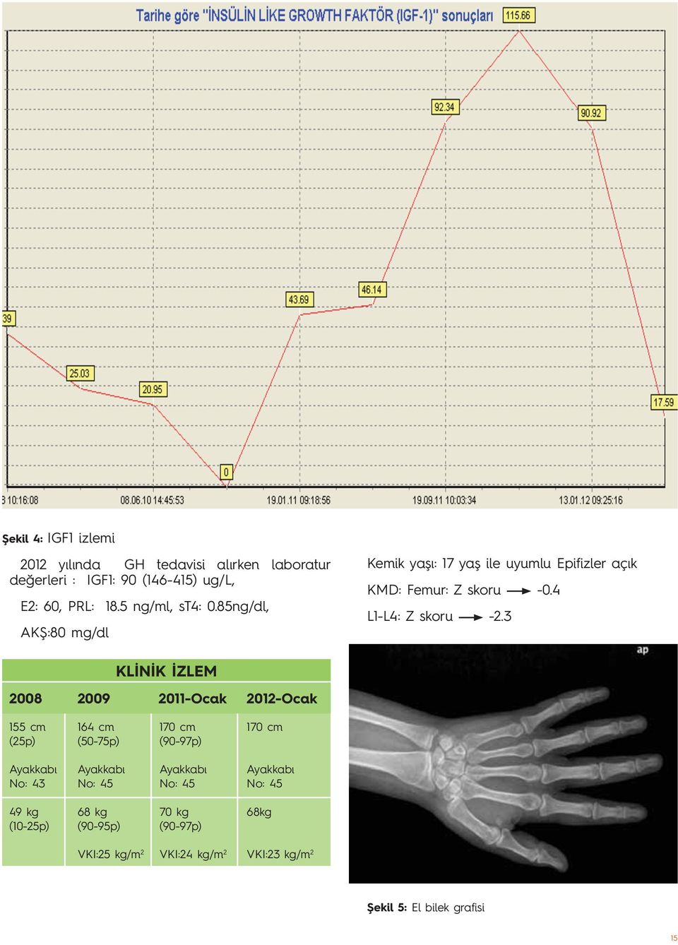 3 KLİNİK İZLEM 2008 2009 2011-Ocak 2012-Ocak 155 cm (25p) 164 cm (50-75p) 170 cm (90-97p) 170 cm Ayakkabı No: 43 Ayakkabı No: 45