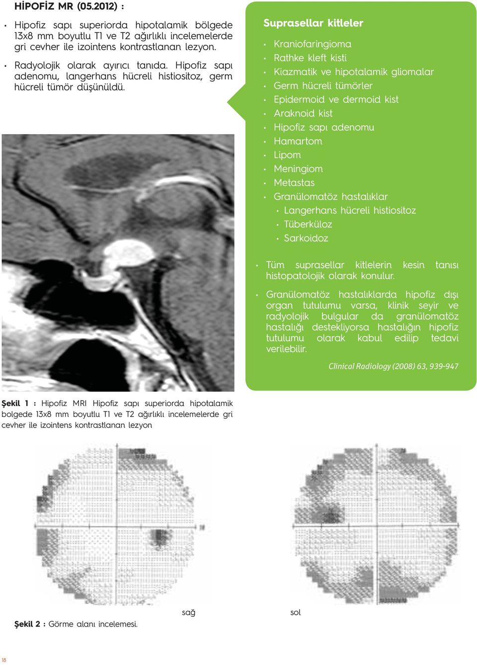 Suprasellar kitleler Kraniofaringioma Rathke kleft kisti Kiazmatik ve hipotalamik gliomalar Germ hücreli tümörler Epidermoid ve dermoid kist Araknoid kist Hipofiz sapı adenomu Hamartom Lipom