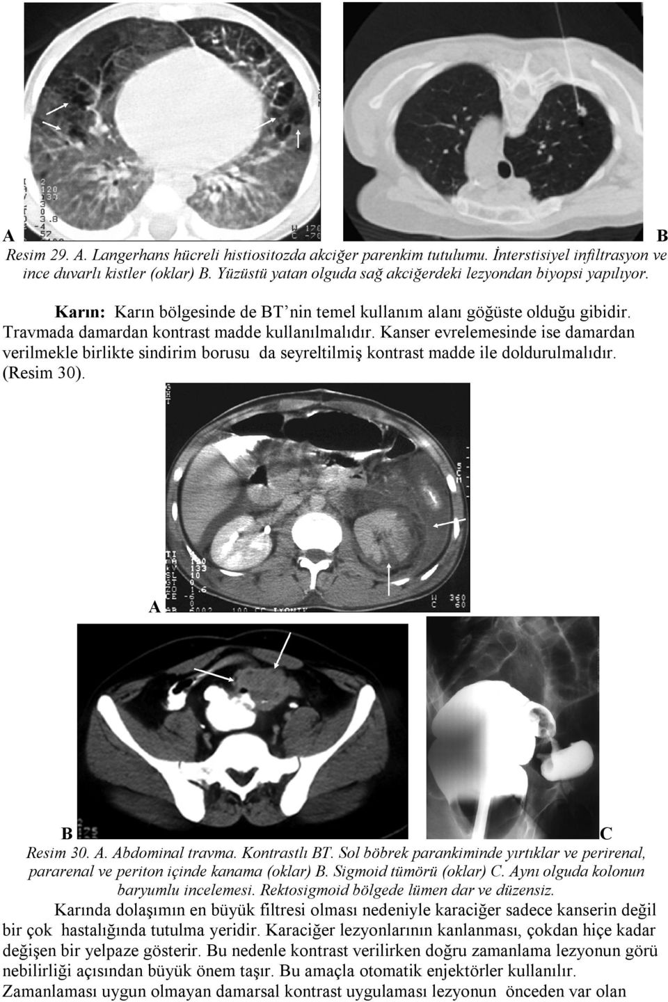 Kanser evrelemesinde ise damardan verilmekle birlikte sindirim borusu da seyreltilmiş kontrast madde ile doldurulmalıdır. (Resim 30). C Resim 30.. bdominal travma. Kontrastlı T.