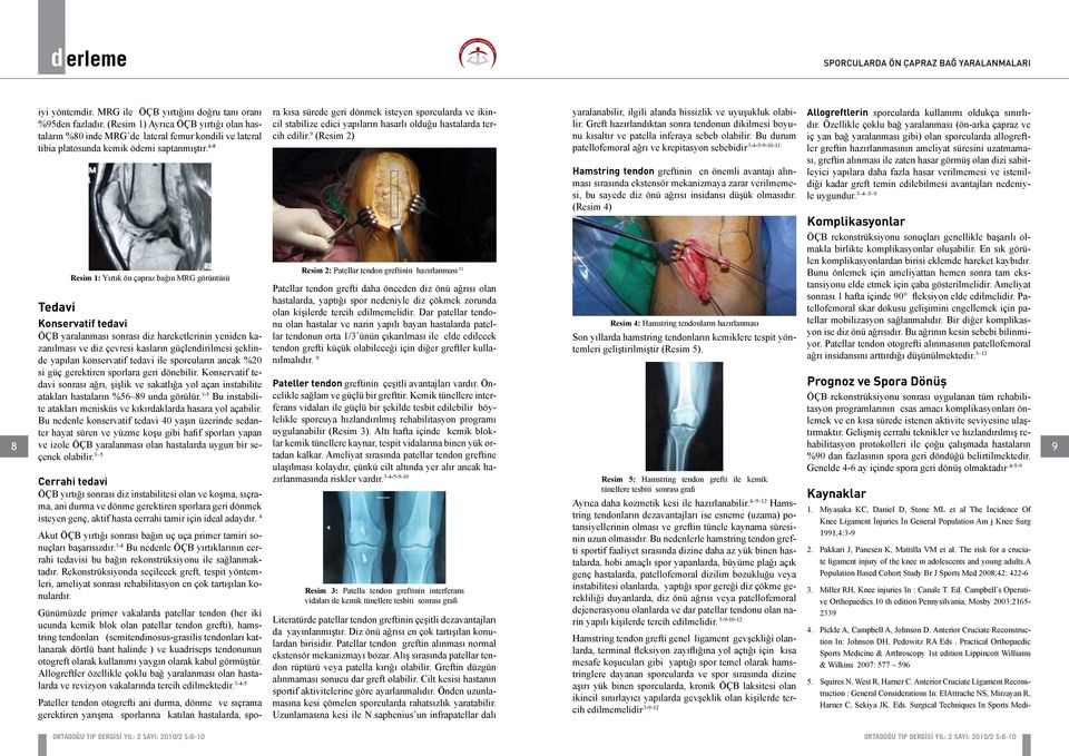 (Resim 1) Ayrıca ÖÇB yırtığı olan hastaların %80 inde MRG de lateral femur kondili ve lateral tibia platosunda kemik ödemi saptanmıştır.