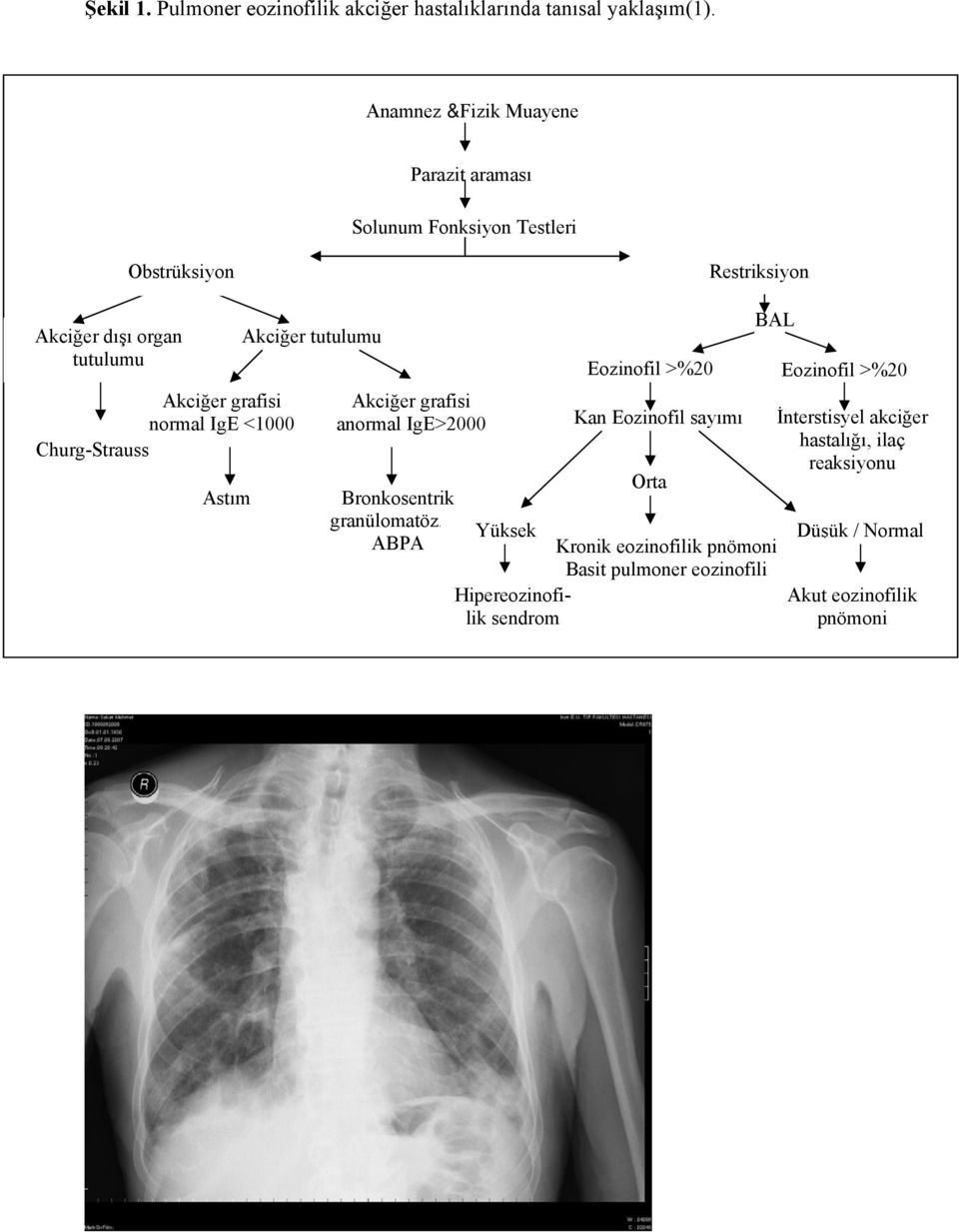 normal IgE <1000 Churg-Strauss Astım Akciğer tutulumu Akciğer grafisi anormal IgE>2000 BAL Eozinofil >%20 Eozinofil >%20 Kan Eozinofil sayımı