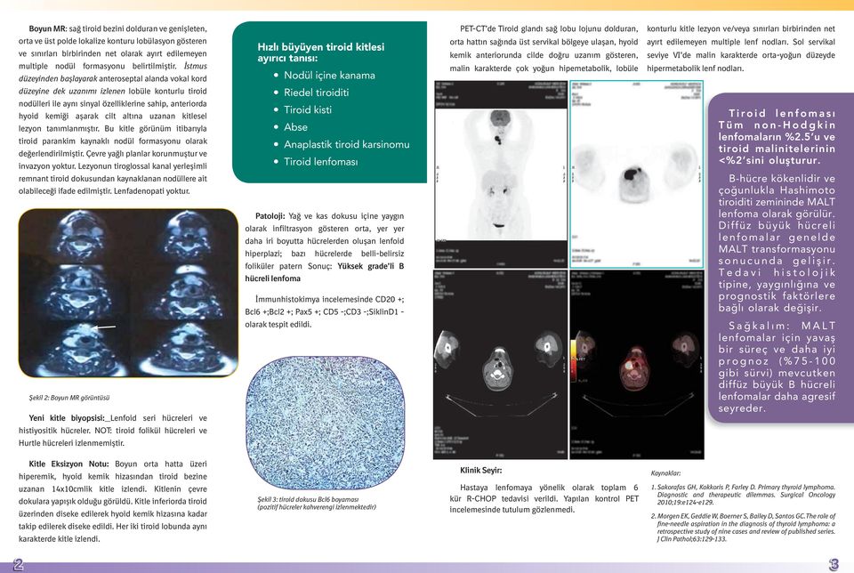 İstmus düzeyinden başlayarak anteroseptal alanda vokal kord düzeyine dek uzanımı izlenen lobüle konturlu tiroid nodülleri ile aynı sinyal özelliklerine sahip, anteriorda hyoid kemiği aşarak cilt