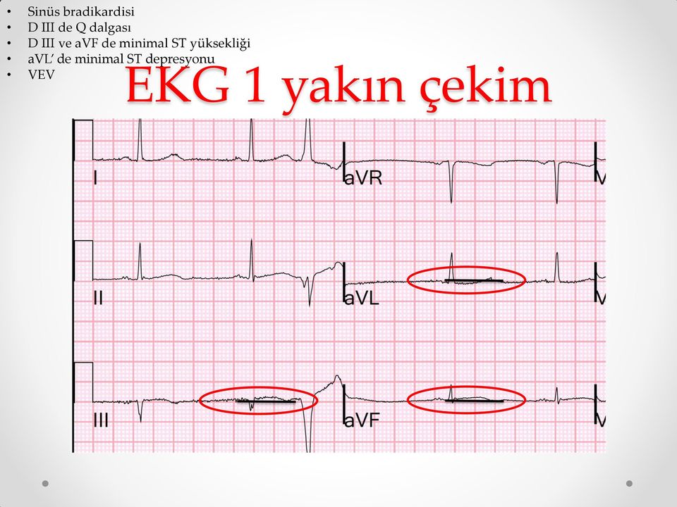 ST yüksekliği avl de minimal ST