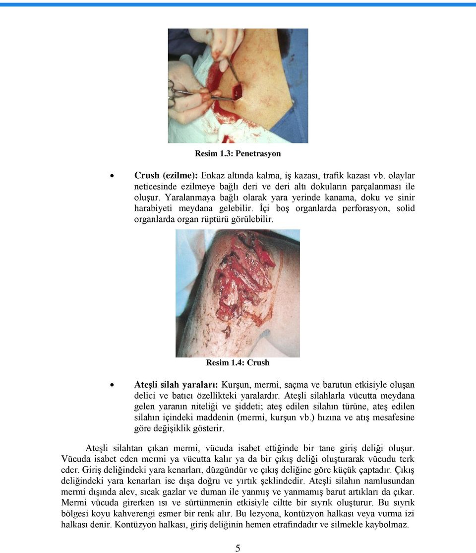 4: Crush Ateşli silah yaraları: Kurşun, mermi, saçma ve barutun etkisiyle oluşan delici ve batıcı özellikteki yaralardır.