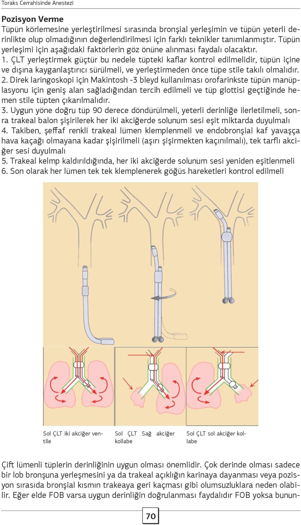 ÇLT yerleştirmek güçtür bu nedele tüpteki kaflar kontrol edilmelidir, tüpün içine ve dışına kayganlaştırıcı sürülmeli, ve yerleştirmeden önce tüpe stile takılı olmalıdır. 2.