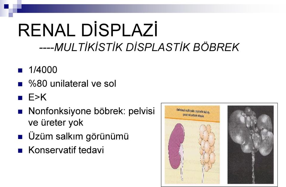 Nonfonksiyone böbrek: pelvisi ve üreter