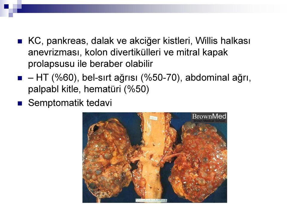 prolapsusu ile beraber olabilir HT (%60), bel-sırt ağrısı