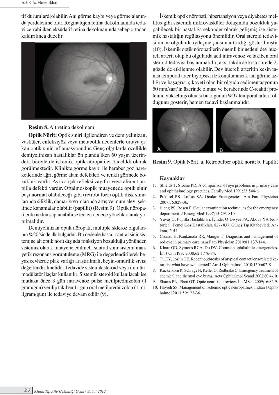 önemlidir. Oral steroid tedavisinin bu olgularda iyileşme şansını arttırdığı gösterilmiştir (10).