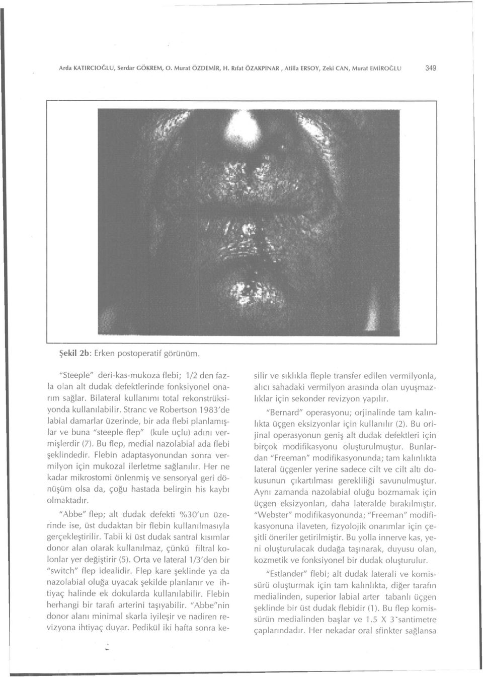 Stranc ve Robertson 1983'de labial damarlar üzerinde, bir ada flebi planlamışlar ve buna "steeple flep" (kule uçlu) adını vermişlerdir (7). Bu flep, medial nazolabial ada flebi şeklindedir.