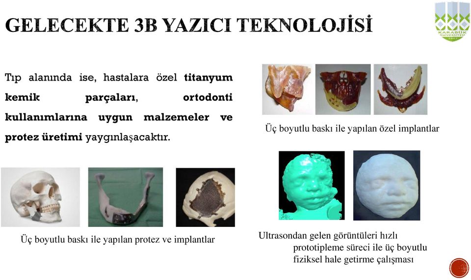 Üç boyutlu baskı ile yapılan özel implantlar Üç boyutlu baskı ile yapılan protez ve