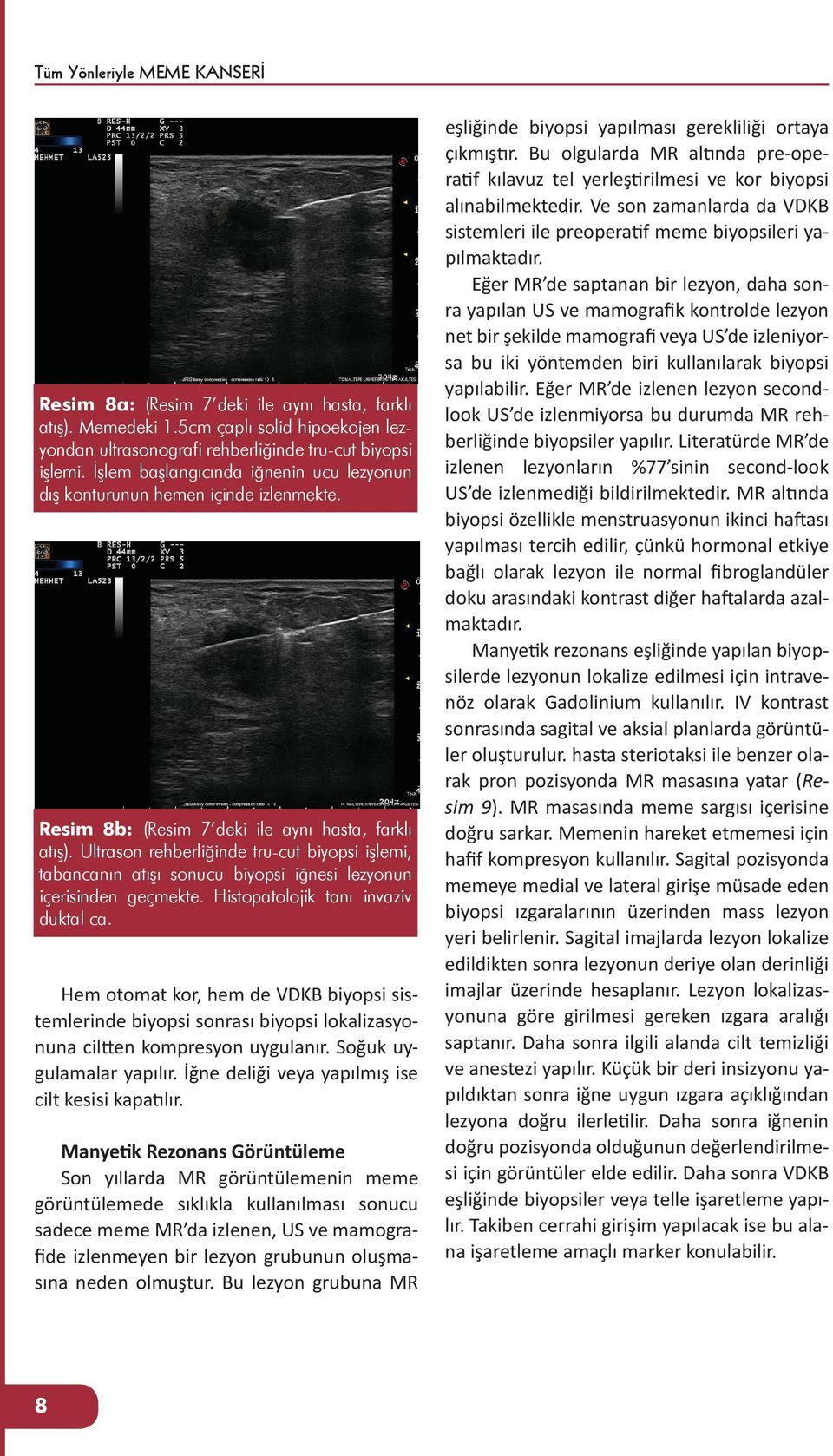 Ultrason rehberliğinde tru-cut biyopsi işlemi, tabancanın atışı sonucu biyopsi iğnesi lezyonun içerisinden geçmekte. Histopatolojik tanı invaziv duktal ca.