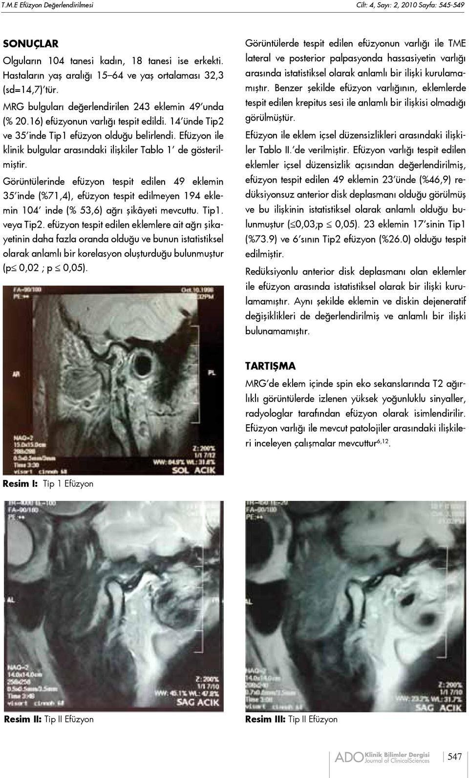 Efüzyon ile klinik bulgular arasındaki ilişkiler Tablo 1 de gösterilmiştir.