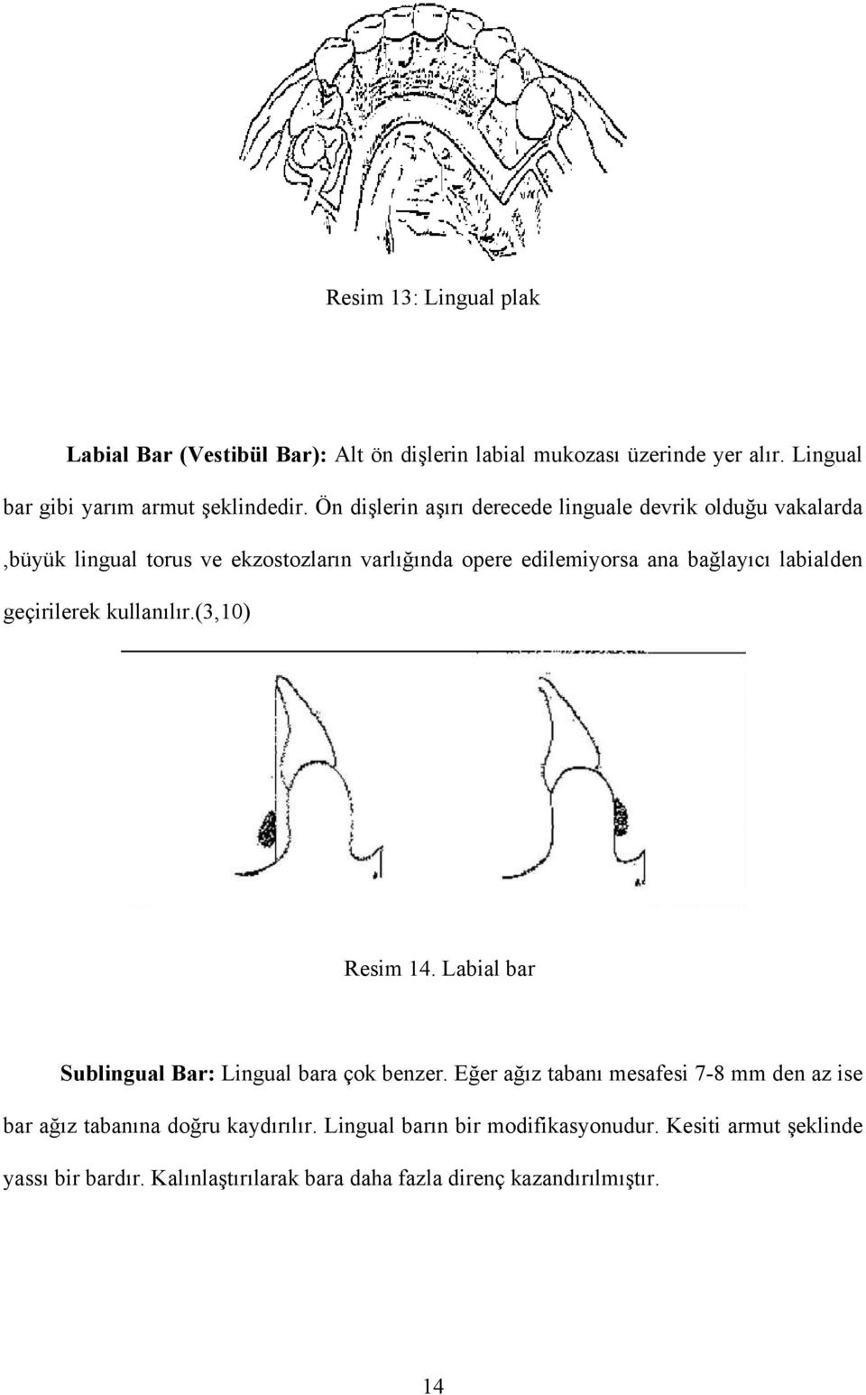 geçirilerek kullanılır.(3,10) Resim 14. Labial bar Sublingual Bar: Lingual bara çok benzer.