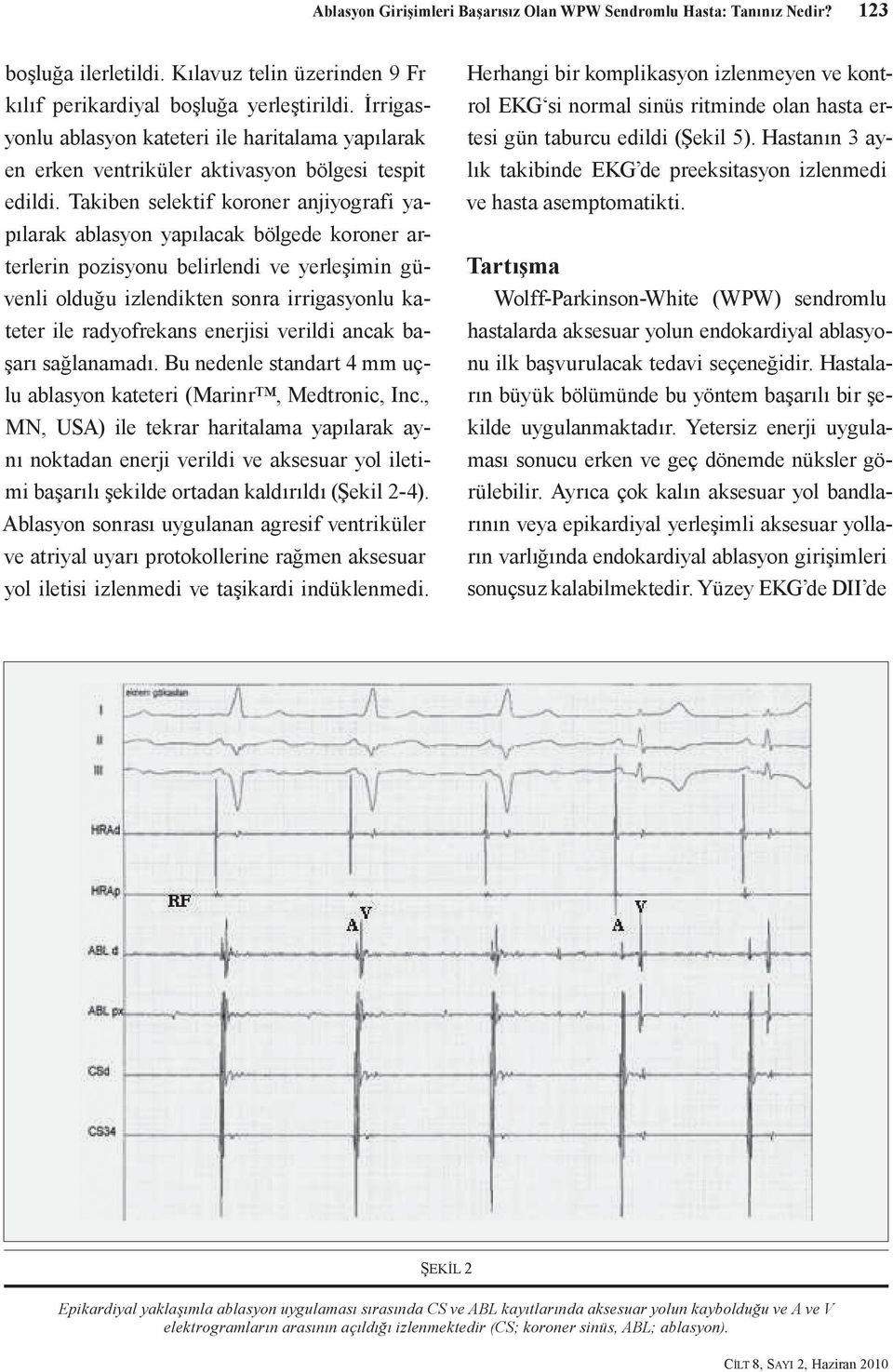 Takiben selektif koroner anjiyografi yapılarak ablasyon yapılacak bölgede koroner arterlerin pozisyonu belirlendi ve yerleşimin güvenli olduğu izlendikten sonra irrigasyonlu kateter ile radyofrekans