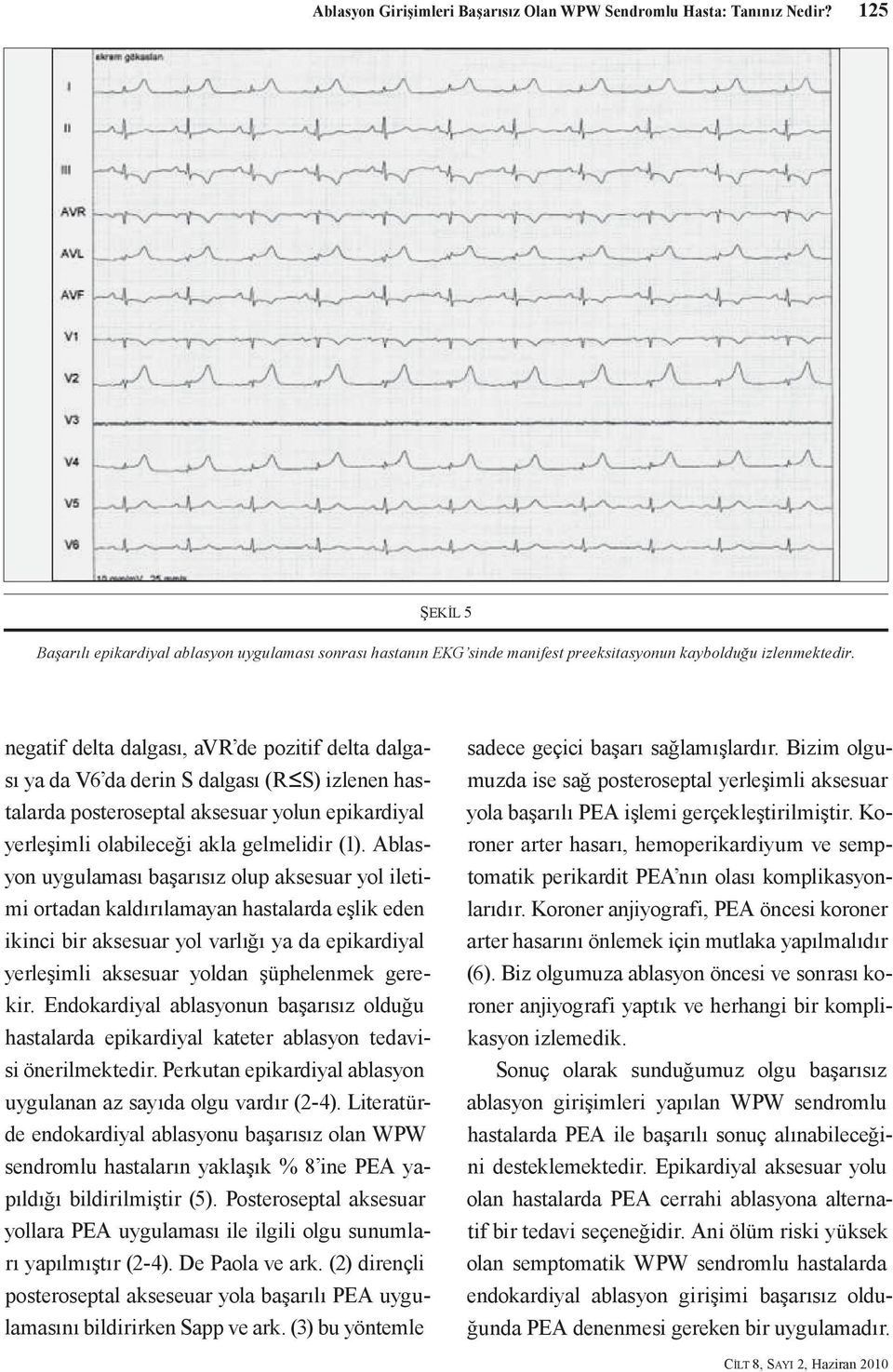 negatif delta dalgası, avr de pozitif delta dalgası ya da V6 da derin S dalgası (R S) izlenen hastalarda posteroseptal aksesuar yolun epikardiyal yerleşimli olabileceği akla gelmelidir (1).