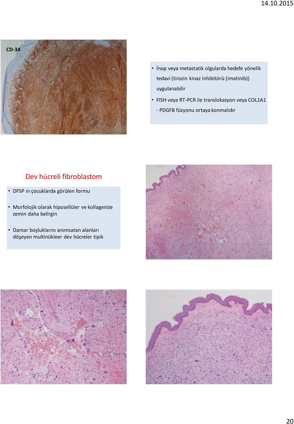 hücreli fibroblastom DFSP ın çocuklarda görülen formu Morfolojik olarak hiposellüler ve