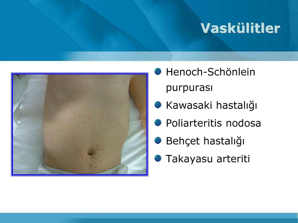 Poliarteritis nodosa Behçet