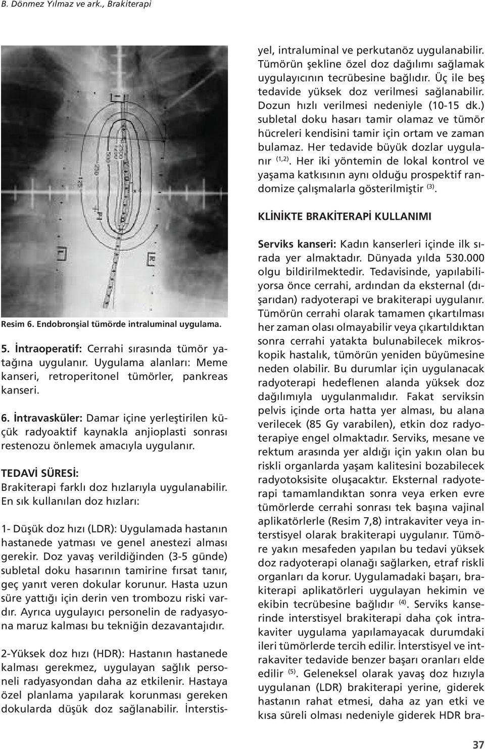 Tümörün şekline özel doz dağılımı sağlamak uygulayıcının tecrübesine bağlıdır. Üç ile beş tedavide yüksek doz verilmesi sağlanabilir. Dozun hızlı verilmesi nedeniyle (10-15 dk.