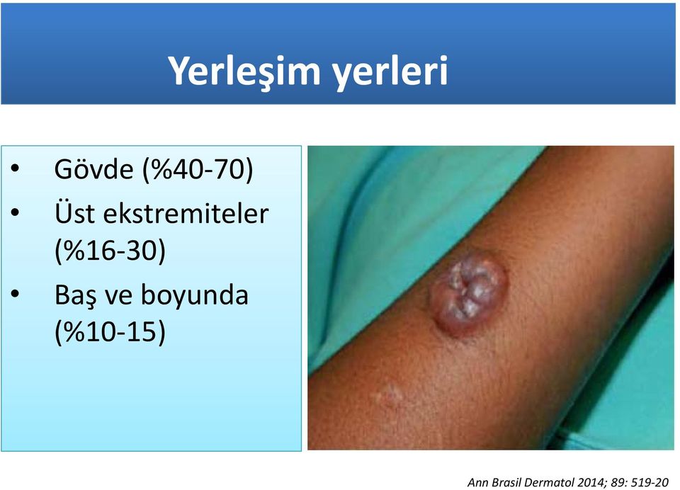 30) Baş ve boyunda (%10 15)