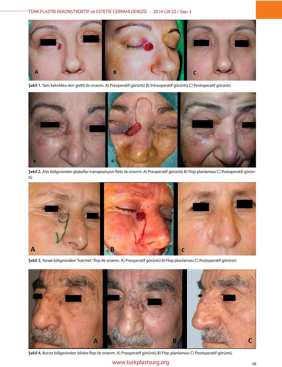 A) Preoperatif görüntü B) Flep planlaması C) Postoperatif görüntü Şekil 3. Yanak bölgesinden hatchet flep ile onarım.