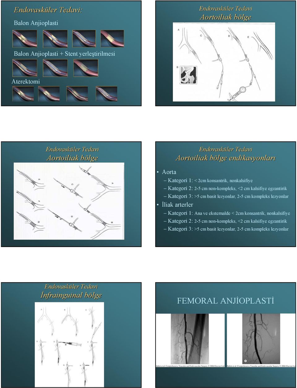 egzantirik Kategori 3: >5 cm basit lezyonlar, 2-5 cm kompleks lezyonlar İliak arterler Kategori 1: Ana ve eksternalde < 2cm konsantrik, nonkalsifiye Kategori 2: