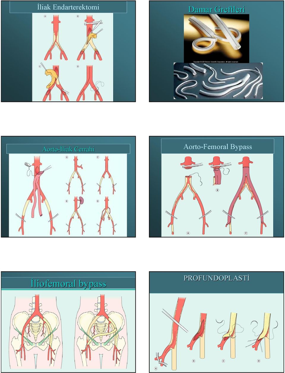 Cerrahi Aorto-Femoral