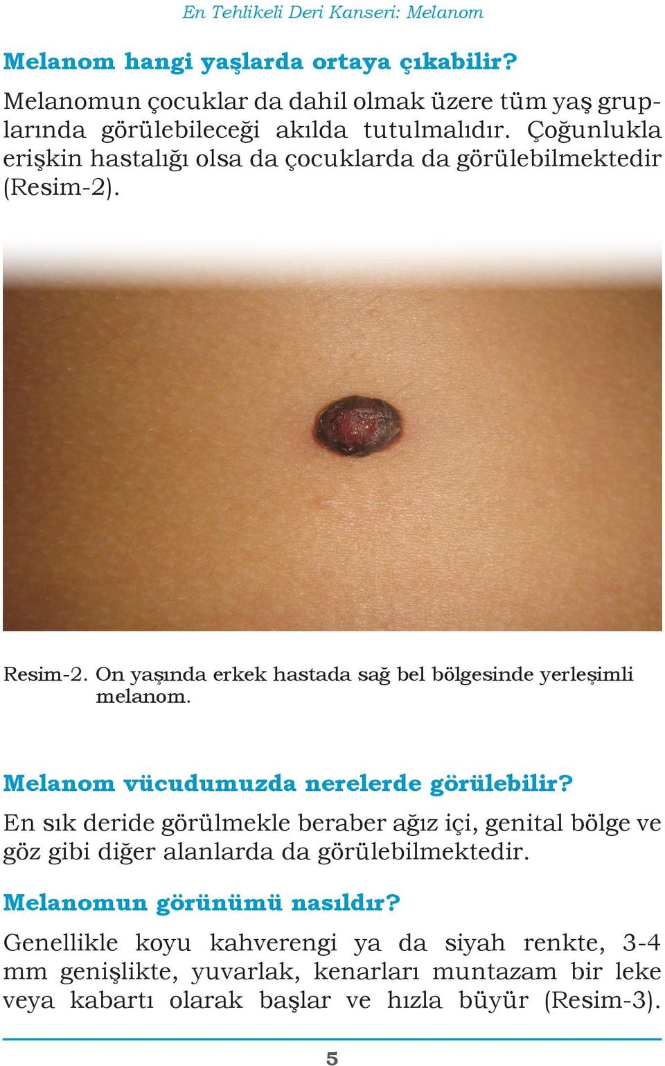 Çoğunlukla erişkin hastalığı olsa da çocuklarda da görülebilmektedir (Resim-2). Resim-2. On yaşında erkek hastada sağ bel bölgesinde yerleşimli melanom.