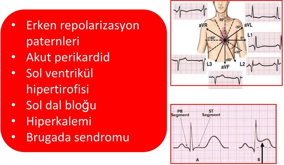 ST Akut elevasyonu perikardid olan hastada EKG ve klinik Sol değerlendirme ventrikül çok doğru bir şekilde