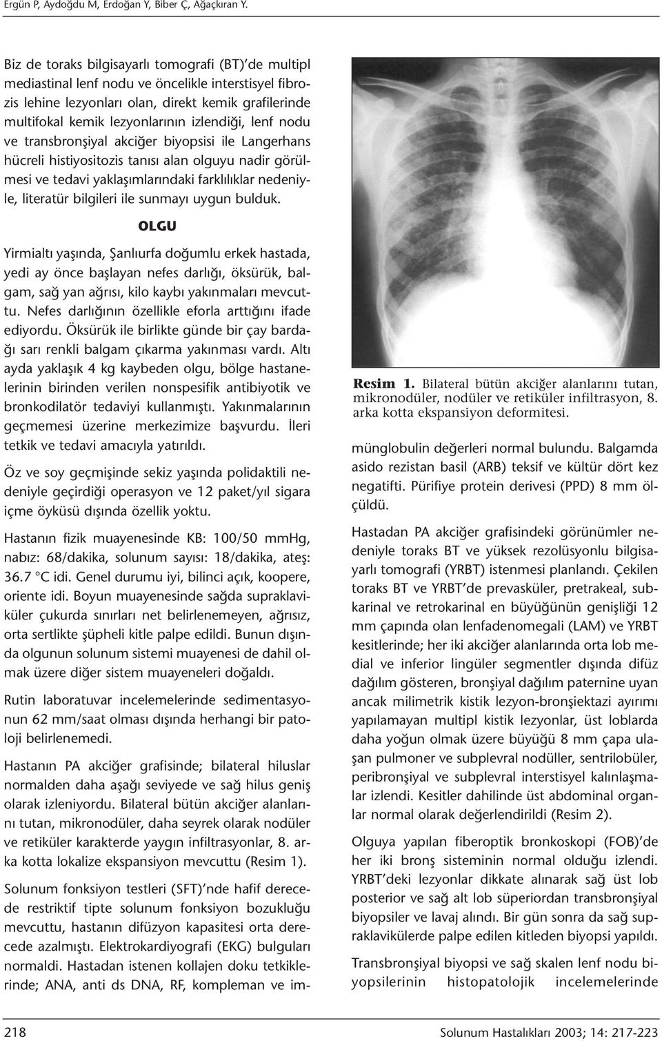 izlendiği, lenf nodu ve transbronşiyal akciğer biyopsisi ile Langerhans hücreli histiyositozis tanısı alan olguyu nadir görülmesi ve tedavi yaklaşımlarındaki farklılıklar nedeniyle, literatür