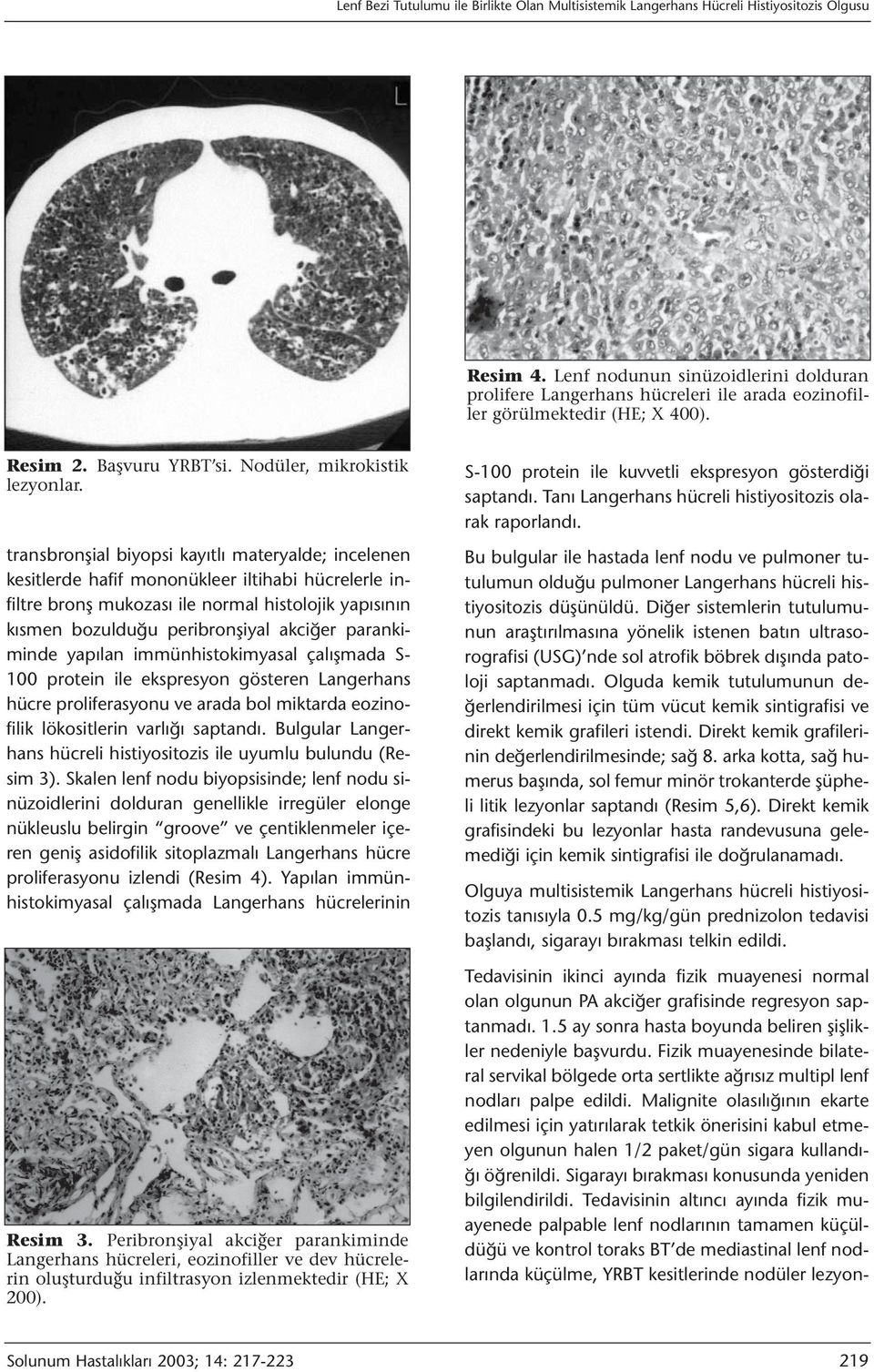 transbronşial biyopsi kayıtlı materyalde; incelenen kesitlerde hafif mononükleer iltihabi hücrelerle infiltre bronş mukozası ile normal histolojik yapısının kısmen bozulduğu peribronşiyal akciğer