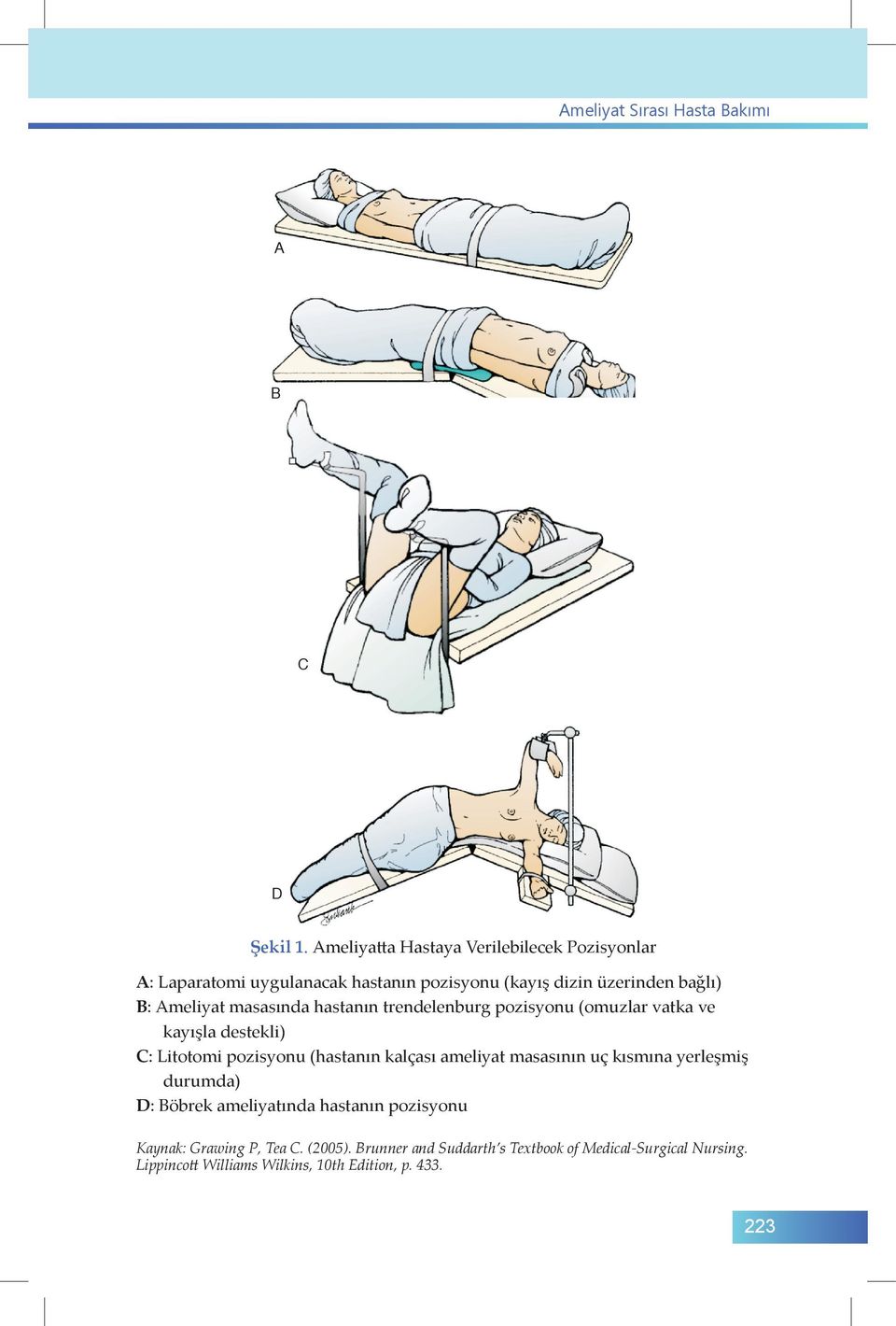 masasında hastanın trendelenburg pozisyonu (omuzlar vatka ve kayışla destekli) C: Litotomi pozisyonu (hastanın kalçası ameliyat