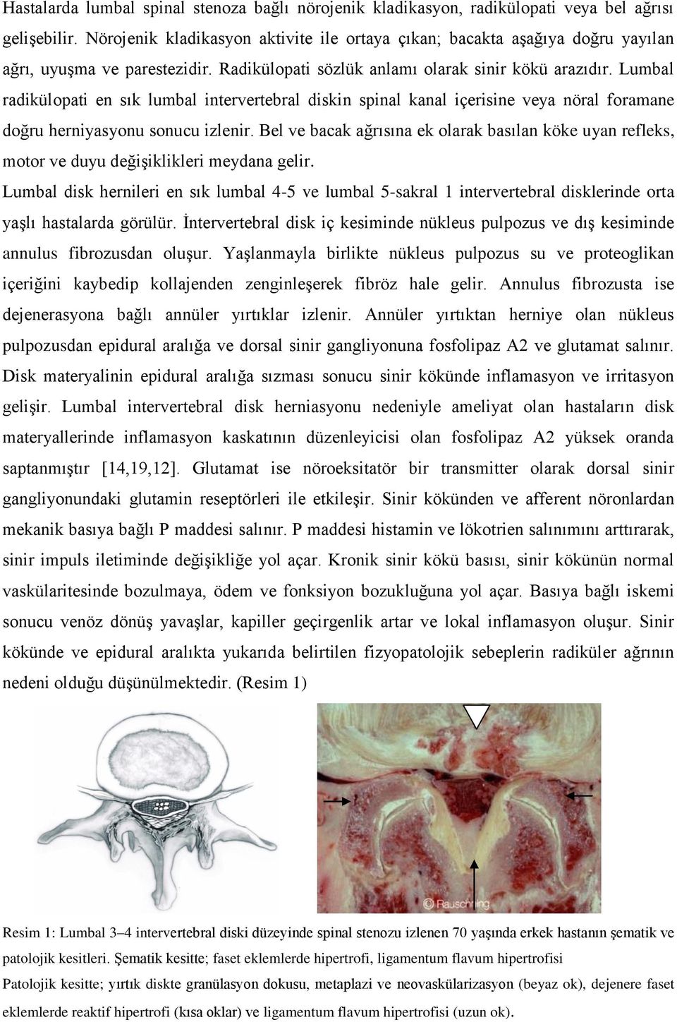 Lumbal radikülopati en sık lumbal intervertebral diskin spinal kanal içerisine veya nöral foramane doğru herniyasyonu sonucu izlenir.