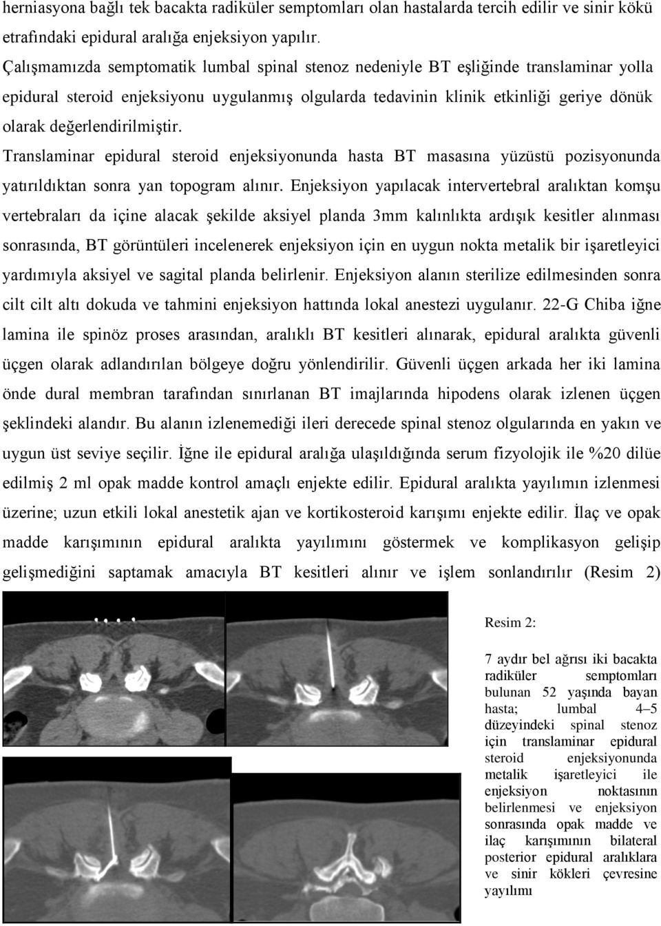 değerlendirilmiştir. Translaminar epidural steroid enjeksiyonunda hasta BT masasına yüzüstü pozisyonunda yatırıldıktan sonra yan topogram alınır.