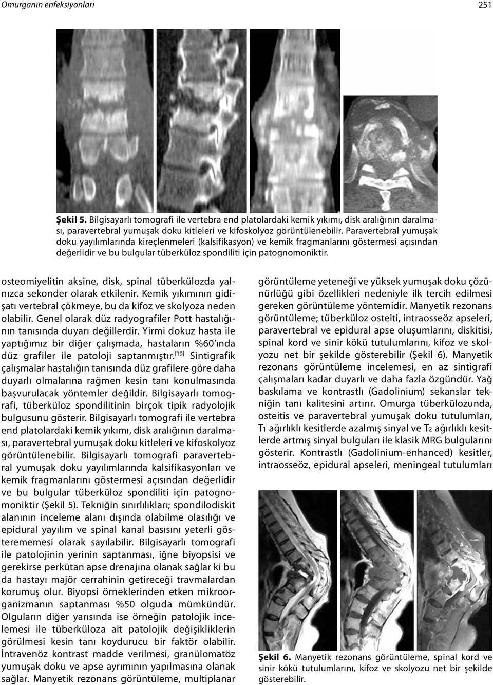 Paravertebral yumuşak doku yayılımlarında kireçlenmeleri (kalsifikasyon) ve kemik fragmanlarını göstermesi açısından değerlidir ve bu bulgular tüberküloz spondiliti için patognomoniktir.