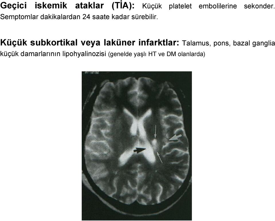 Küçük subkortikal veya laküner infarktlar: Talamus, pons, bazal