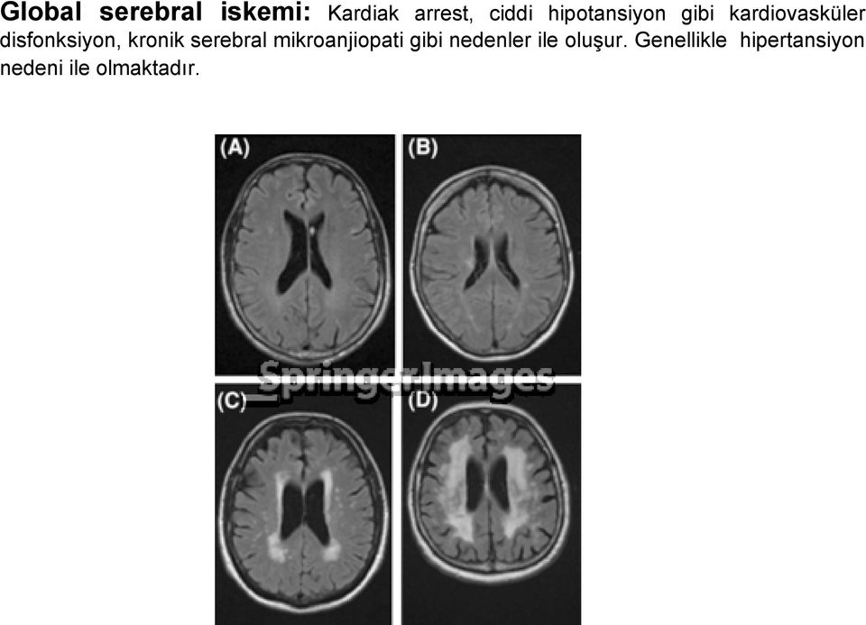 kronik serebral mikroanjiopati gibi nedenler ile