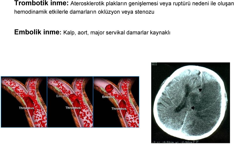 hemodinamik etkilerle damarların oklüzyon veya