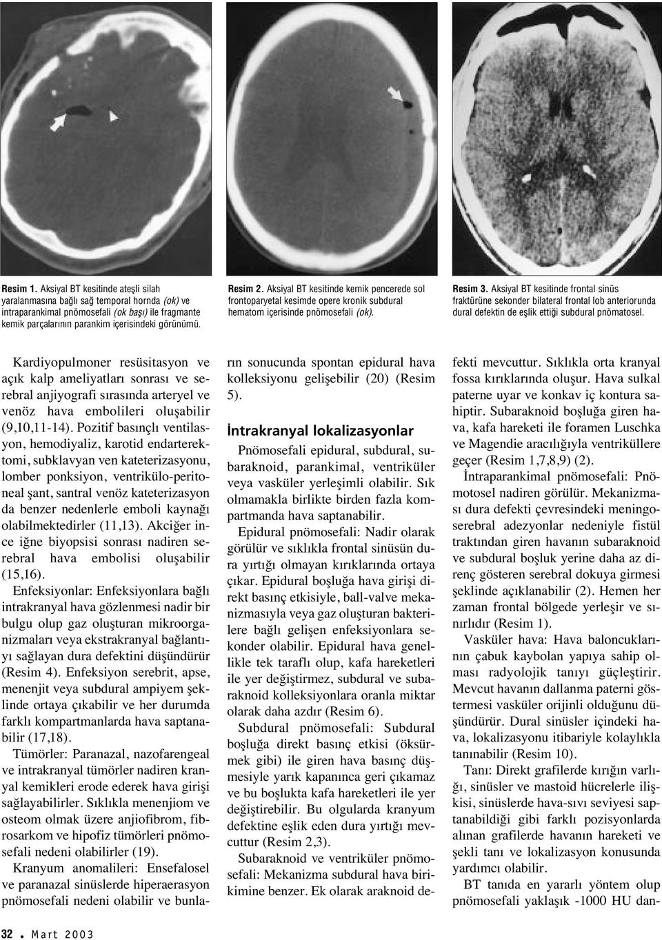 Aksiyal BT kesitinde frontal sinüs fraktürüne sekonder bilateral frontal lob anteriorunda dural defektin de efllik etti i subdural pnömatosel.