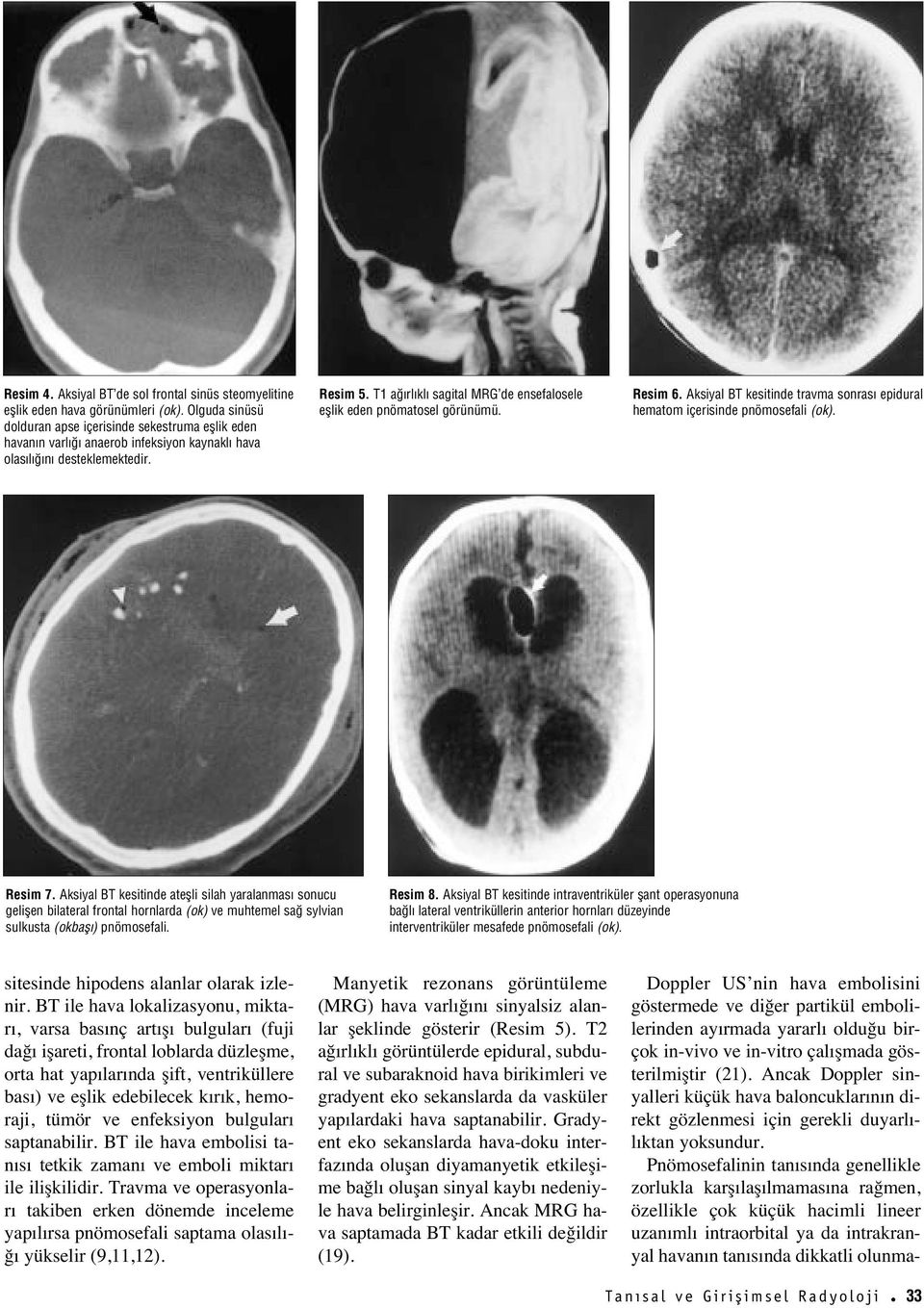 T1 a rl kl sagital MRG de ensefalosele efllik eden pnömatosel görünümü. Resim 6. Aksiyal BT kesitinde travma sonras epidural hematom içerisinde pnömosefali (ok). Resim 7.