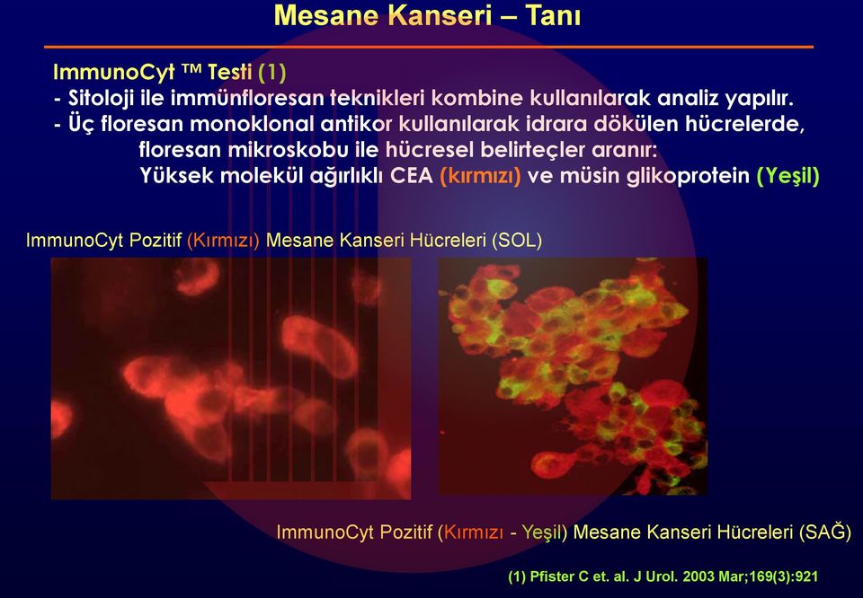 aranır: Yüksek molekül ağırlıklı CEA (kırmızı) ve müsin glikoprotein (Yeşil) ImmunoCyt Pozitif (Kırmızı) Mesane Kanseri