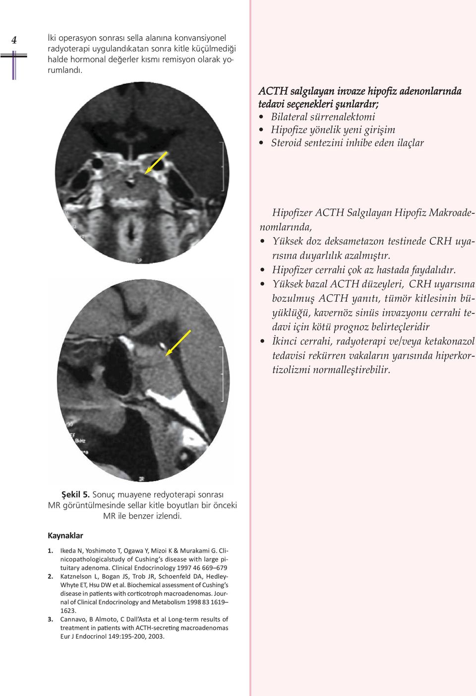 Hipofiz Makroadenomlarında, Yüksek doz deksametazon testinede CRH uyarısına duyarlılık azalmıştır. Hipofizer cerrahi çok az hastada faydalıdır.