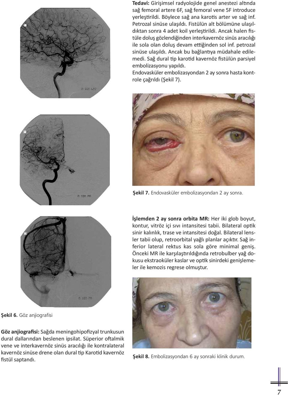 petrozal sinüse ulaşıldı. Ancak bu bağlan ya müdahale edilemedi. Sağ dural p karo d kavernöz fistülün parsiyel embolizasyonu yapıldı.